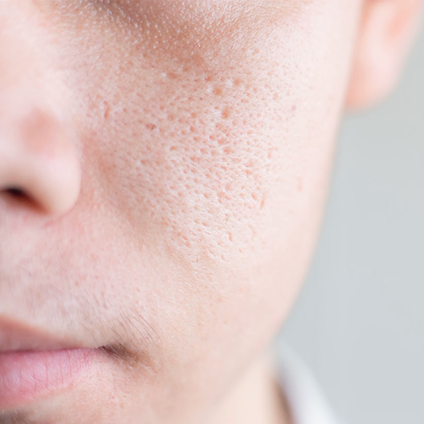 Lady suffering from acne issues